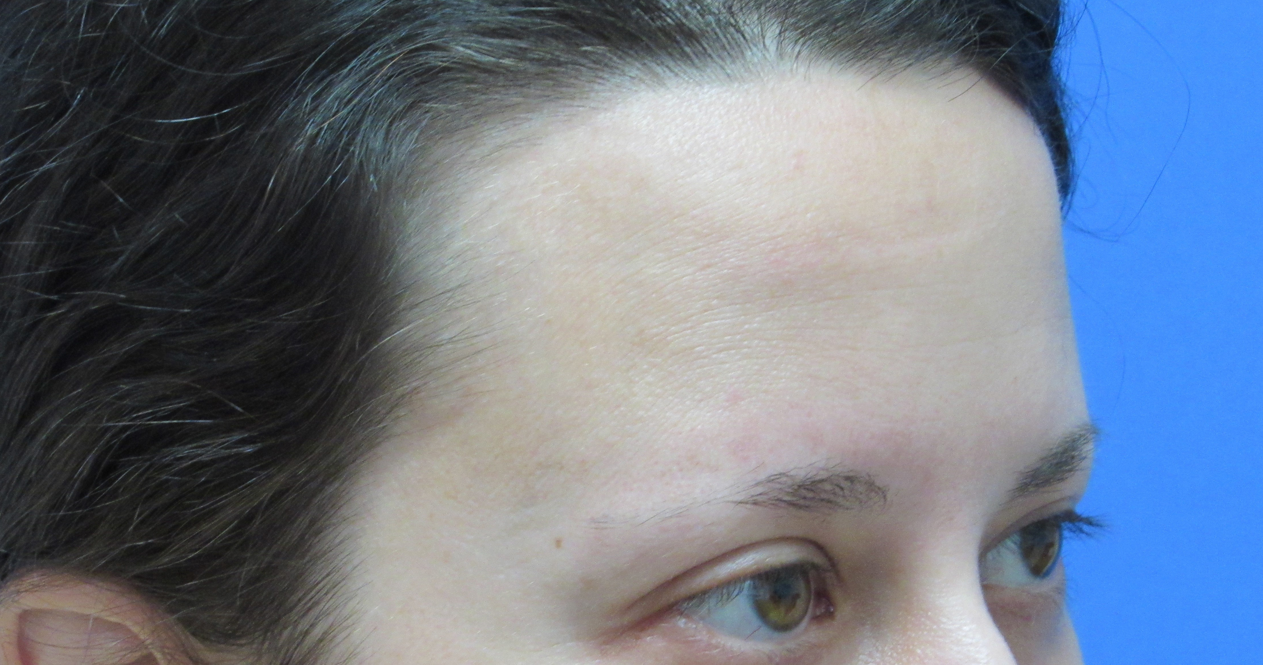 Eyebrow Transplant Before and After | Wolfeld