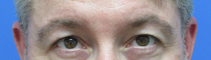 Eyebrow Transplant Before and After | Wolfeld