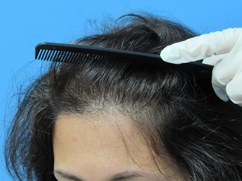 Female Hair Transplant Before and After | Wolfeld