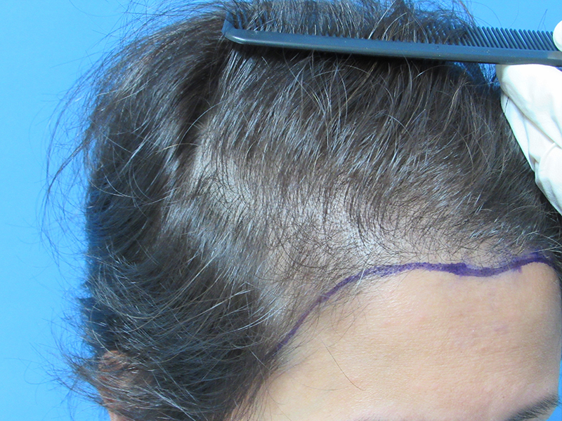 Female Hair Transplant Before and After | Wolfeld