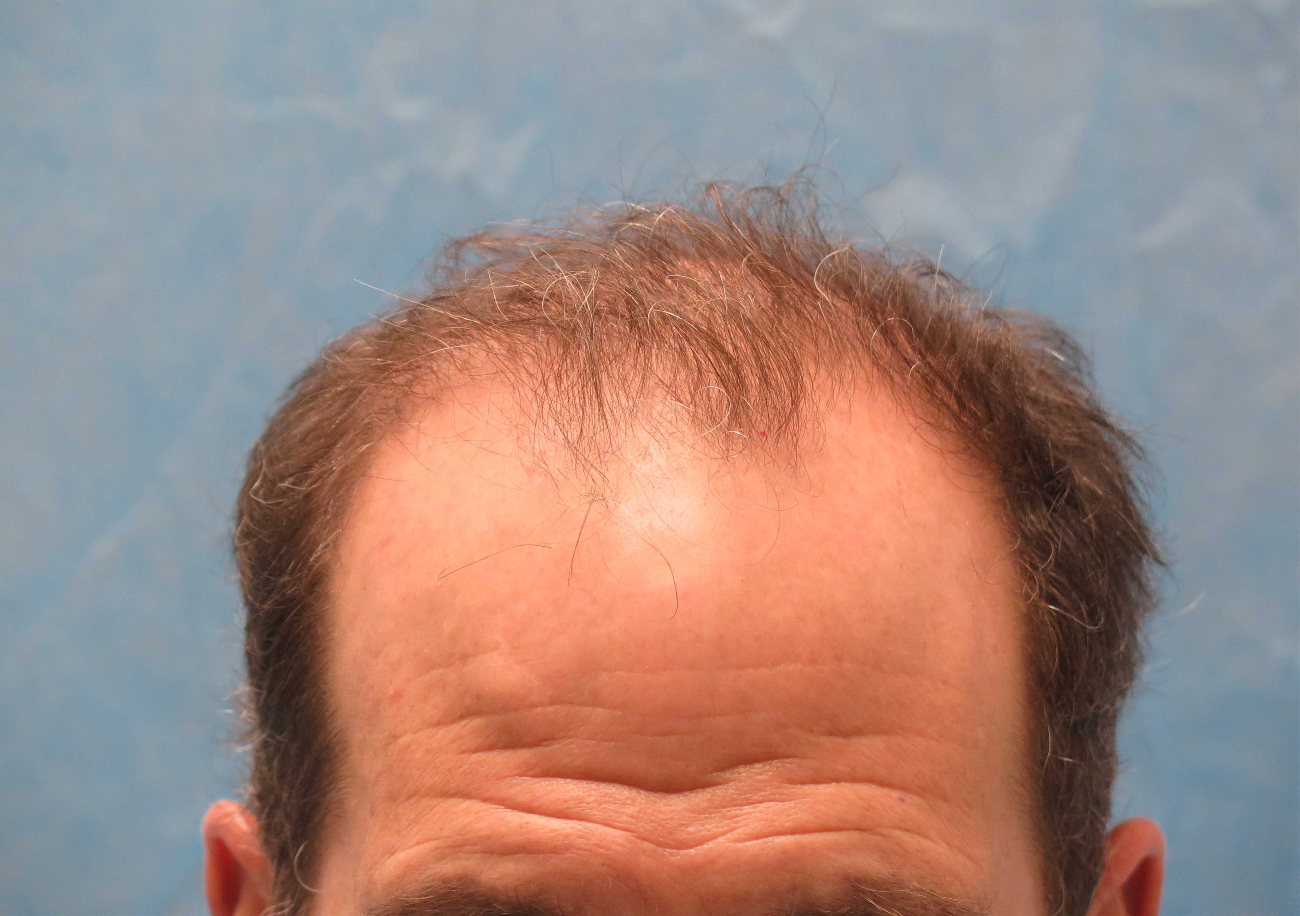 Male Hair Transplant Before and After | Wolfeld