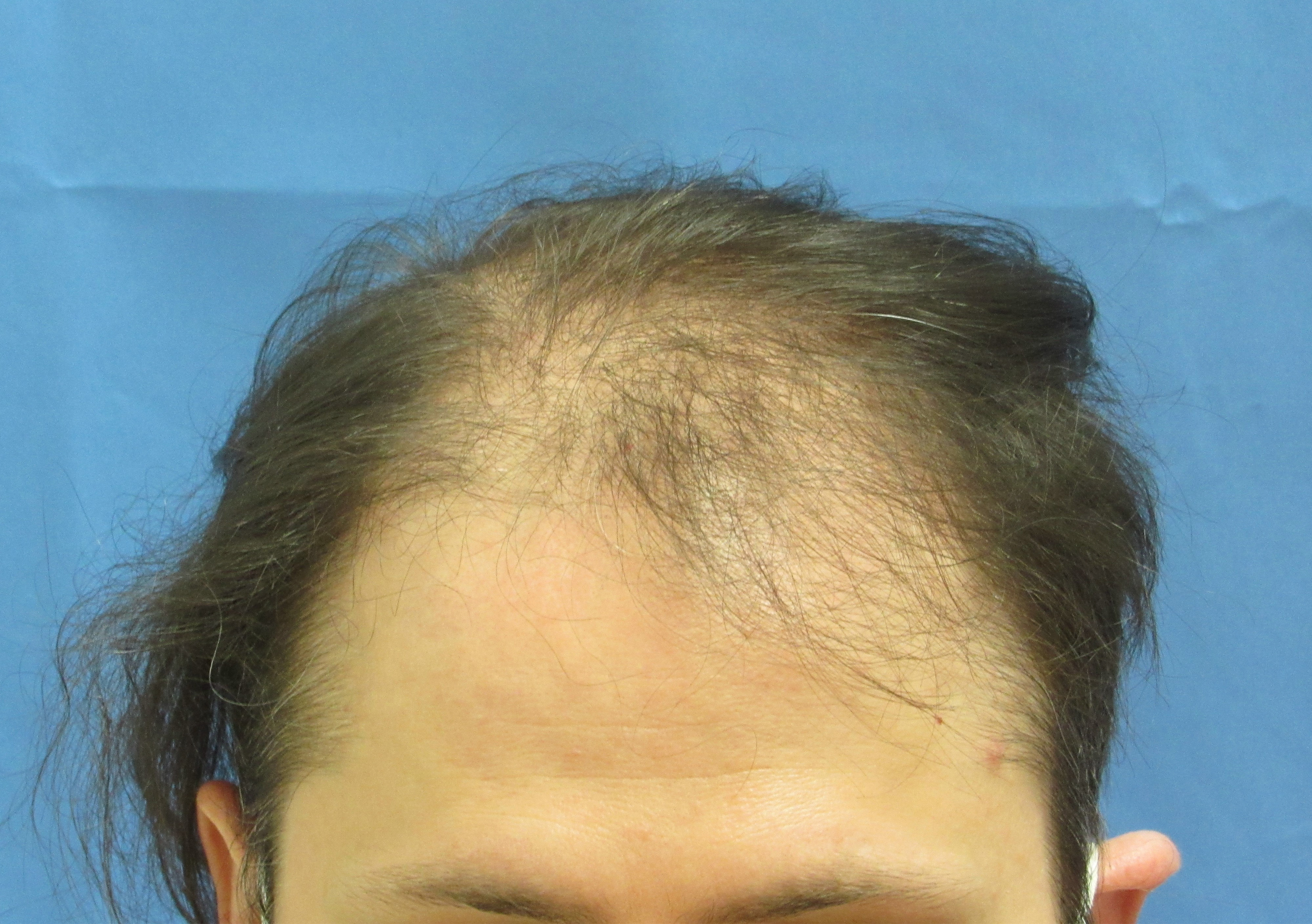 Male Hair Transplant Before and After 08 | Wolfeld