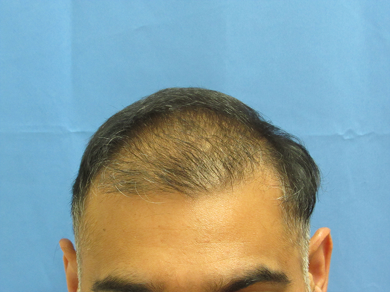 Male Hair Transplant Before and After | Wolfeld