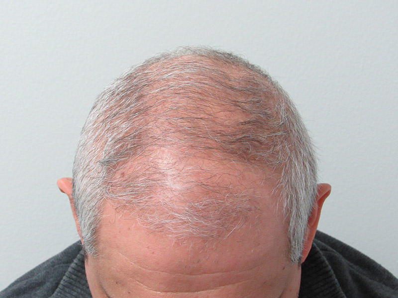 Before PRP hair loss treatment in NYC with Dr. Wolfeld