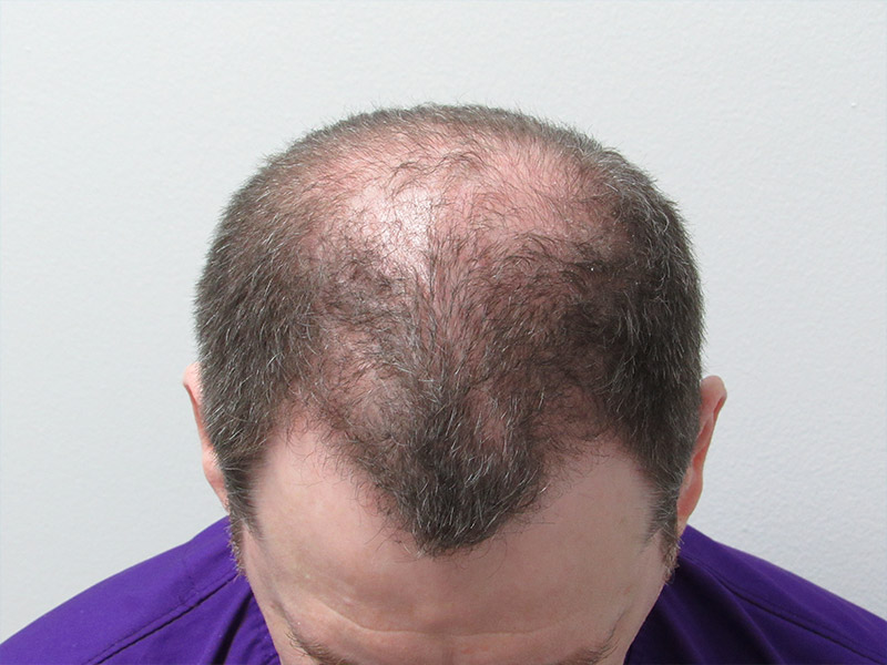 Before PRP hair treatment in New York with Dr. Wolfeld