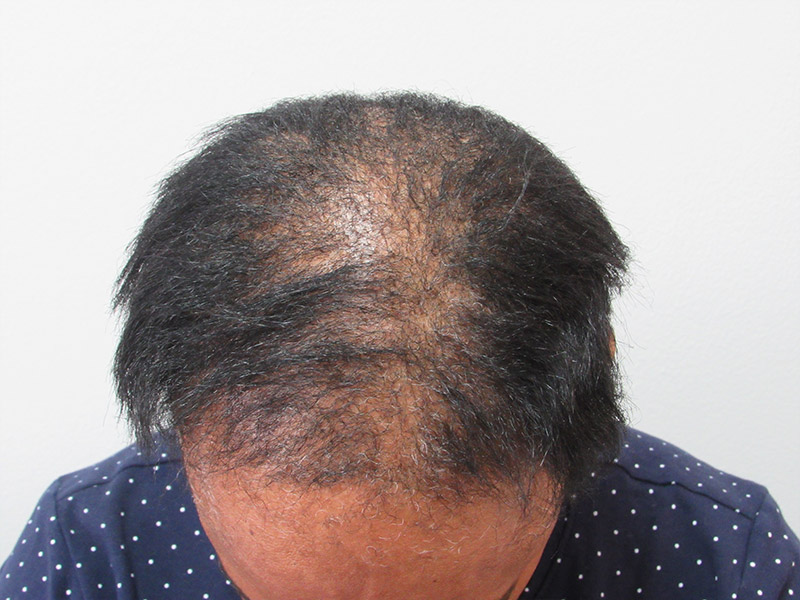 Before PRP hair loss treatment in New York with Dr. Wolfeld