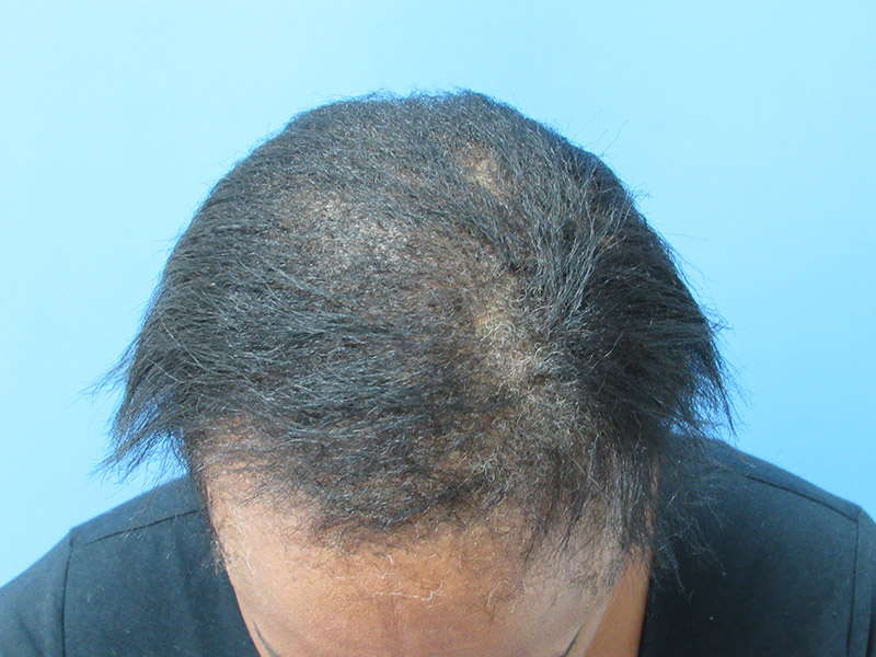 After PRP hair loss treatment in New York with Dr. Wolfeld