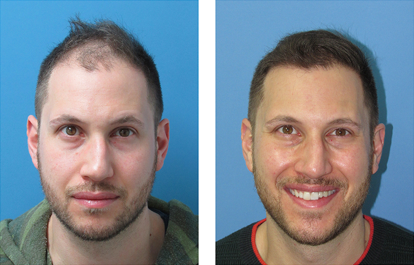 Hair Transplant NYC | Best NYC Hair Restoration