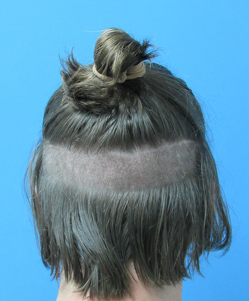 Long Hair FUE Transplant NYC | Wolfeld Hair
